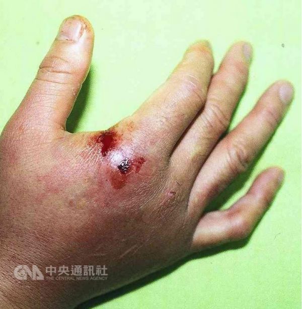 養魟魚當寵物 熟男不慎被刺手背潰爛